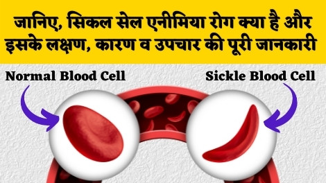 Sickle Cell Anemia in Hindi